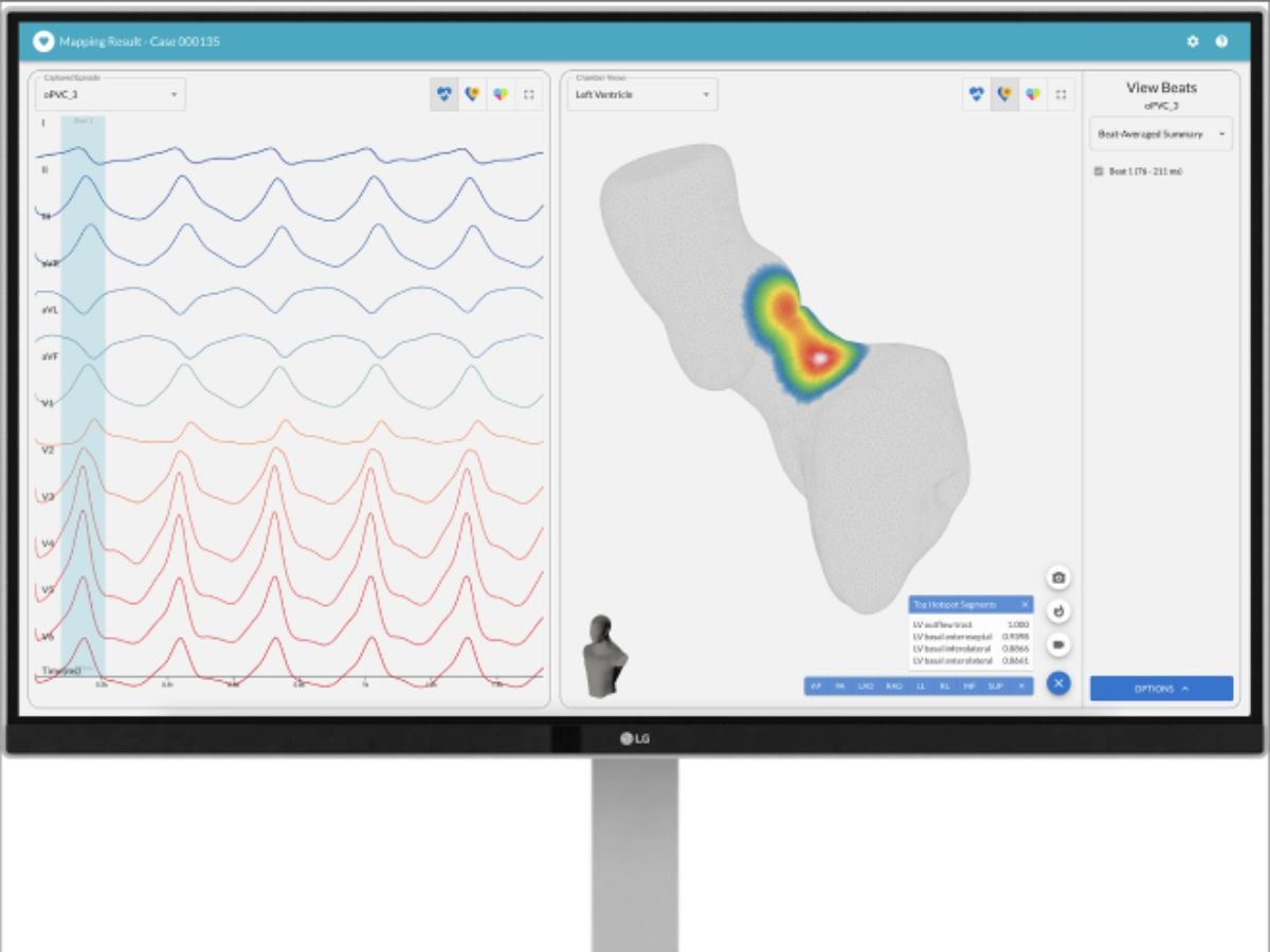 Ascension St. Vincent’s Riverside launches study of FDA-cleared technology that helps treat irregular heartbeats