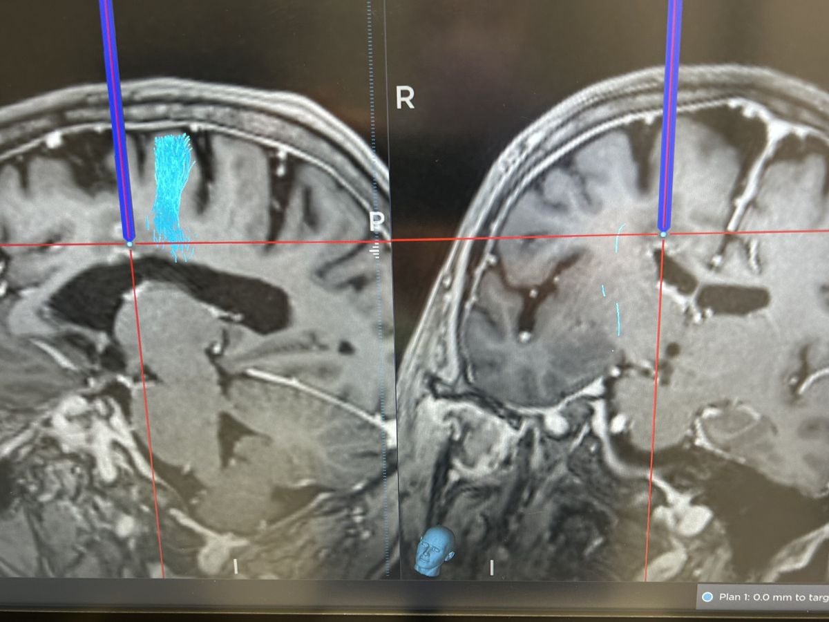 Ascension St. Vincent’s Riverside adds minimally invasive laser procedure to treat brain tumors