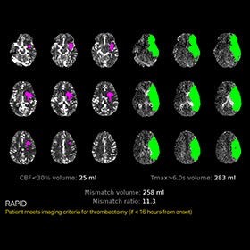 Comprehensive Stroke Center utilizing artificial intelligence tool to quickly diagnose strokes, improve outcomes